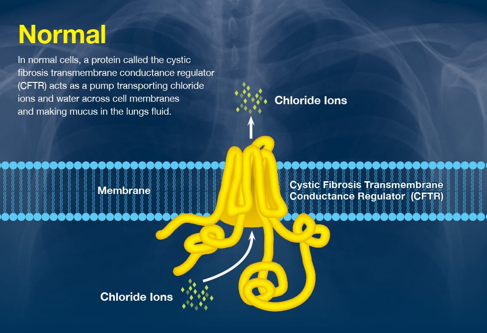 Cystic-Fibrosis-full-page-slides-1.jpg