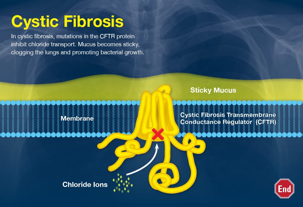 Cystic-Fibrosis-full-page-slides-2.jpg