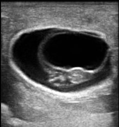 ultrasound